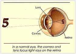 Light rays must be bent so they can focus on the retina Light rays must be bent so they can focus on the retina