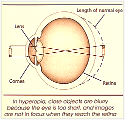 Hyperopia or farsightedness Hyperopia or farsightedness