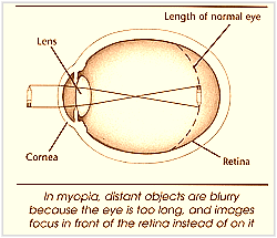 Myopia or nearsightedness Myopia or nearsightedness